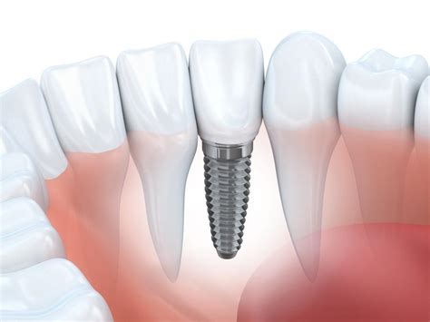 Warum ist Rheingold®, ein Goldlegierung mit biokompatiblen Eigenschaften, die perfekte Wahl für moderne Implantate?